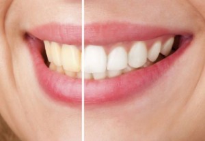 自然な方法でどうやって歯を白くする?