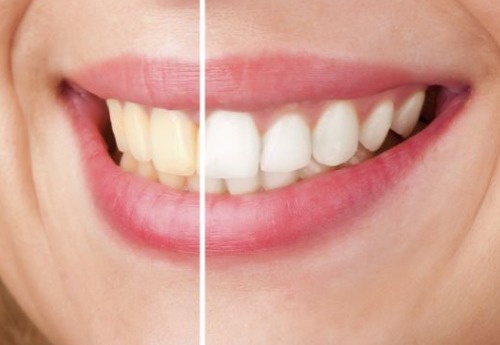 自然な方法でどうやって歯を白くする？