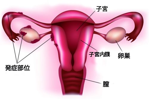 子宮内膜症の主な症状 みんな健康 子宮内膜症の主な症状