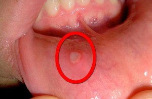 気になる口内炎を治す方法