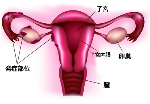 子宮内膜症の主な症状