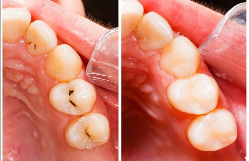 虫歯：要因と自然療法