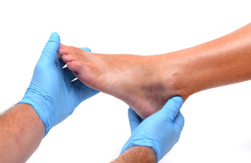 足首や足のむくみ：原因と予防