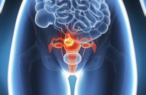 子宮がんの６割は予防できるってほんと？