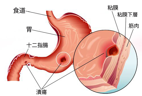 胃潰瘍の自然な治療法