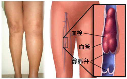 血栓症１