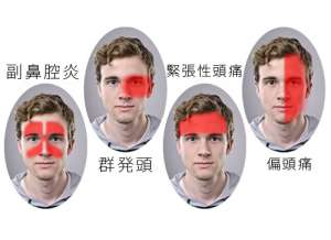 偏頭痛を治すための画期的な新方法