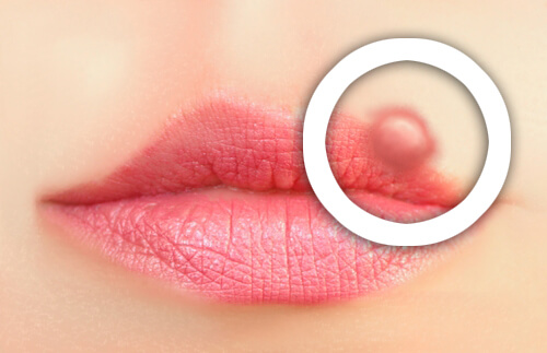 口唇ヘルペスの予防法