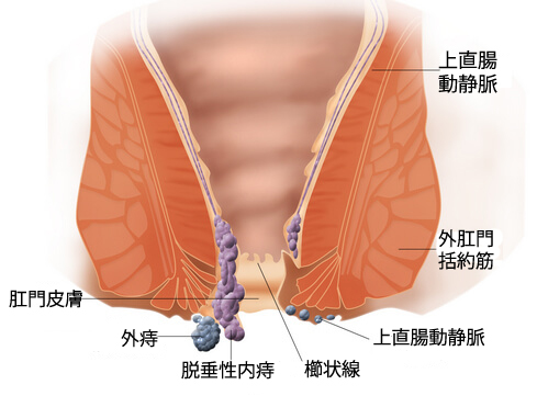 カモミールを使った痔の自然療法1