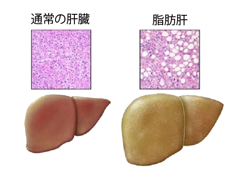 脂肪肝と通常の肝臓