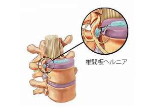 椎間板ヘルニアの兆候とは？