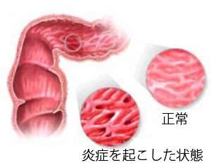 ご用心！ 過敏性腸症候群の人が/食べてはいけない食品
