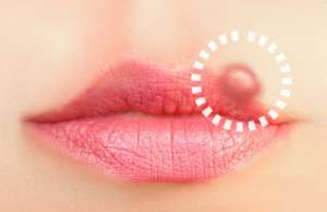 口唇ヘルペスに効く10の自然療法