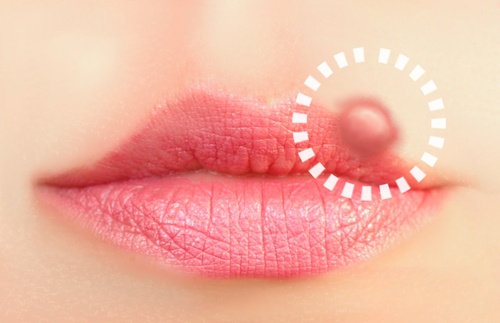 口唇ヘルペスに効く10の自然療法