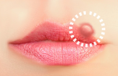 口唇ヘルペスに効く１０の自然療法
