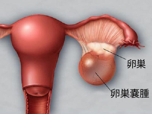 卵巣嚢腫の予防と早期発見