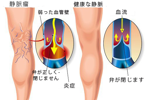 静脈瘤