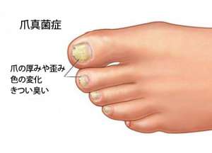 家庭でできる爪真菌症治療