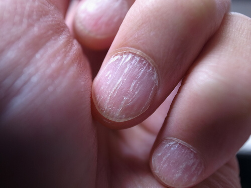 手の爪真菌症