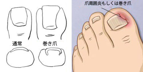 足の巻き爪 の症状
