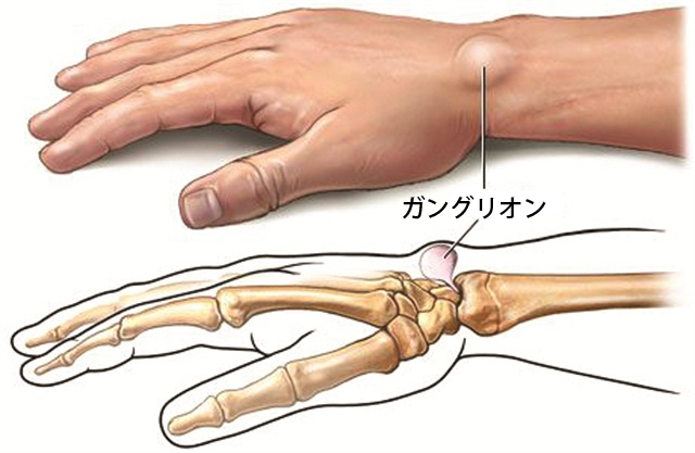 手や手首の痛みの原因