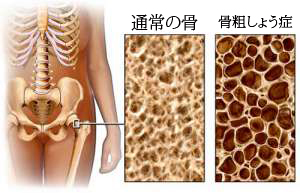 骨粗しょう症をふせぐ食生活 骨粗しょう症をふせぐ食生活