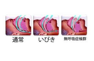 いびき解消法