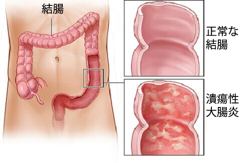 皮膚にできる白い斑点 これって一体何 みんな健康