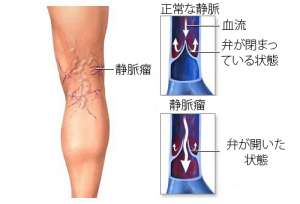 静脈瘤に効果的な5つの薬草