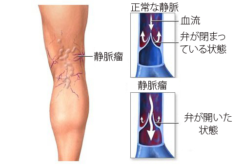 静脈瘤に効果的な5つの薬草