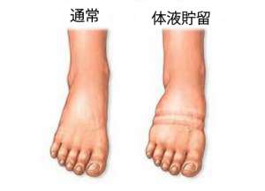 体液貯留の対処法