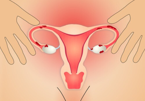 子宮内膜症のための食事療法