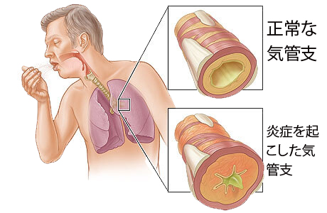 慢性気管支炎1