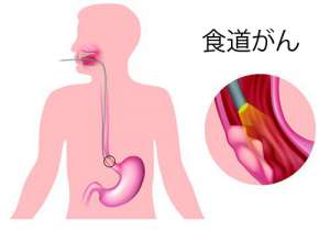 あなたには当てはまりませんか？/食道疾患の症状