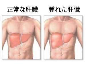 「肝臓 腫れる」の画像検索結果