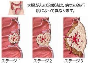 大腸がんについて/知っておくべきことがら