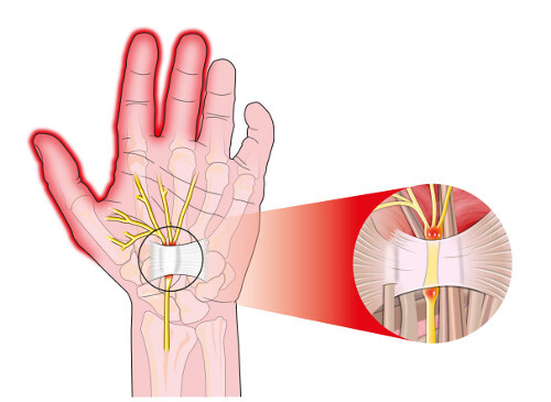 手根管症候群の痛みを軽減する5つの方法