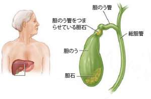胆石があるってどうしたらわかるの?
