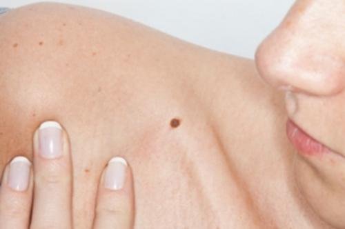 moles