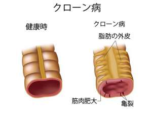 クローン病の症状と治療