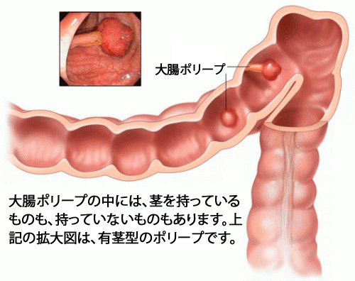 大腸ポリープ 1