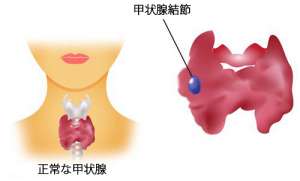 しこりが良性か悪性か見極める方法