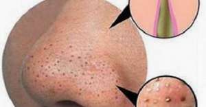 ニキビと毛穴の黒ずみを/自然に解消するには