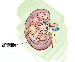 腎嚢胞