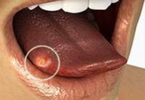 舌の潰瘍