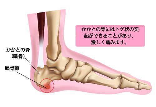 踵骨棘の予防