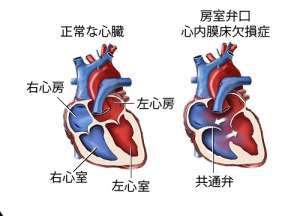 心雑音って何？知っておきたい心雑音の７つの症状