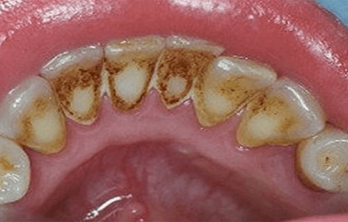 歯石を除去し口内の健康を改善する方法