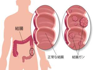 結腸ガン予防のための5つのヒント