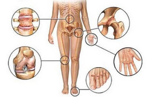 関節痛のための抗炎症自然療法5種